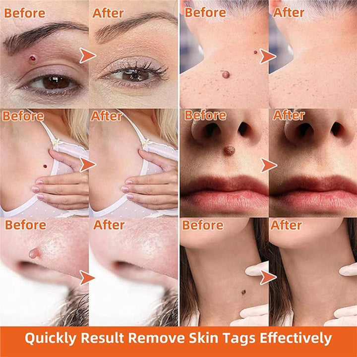 Auto Skin Tag Remover | Quick Band Application Kit