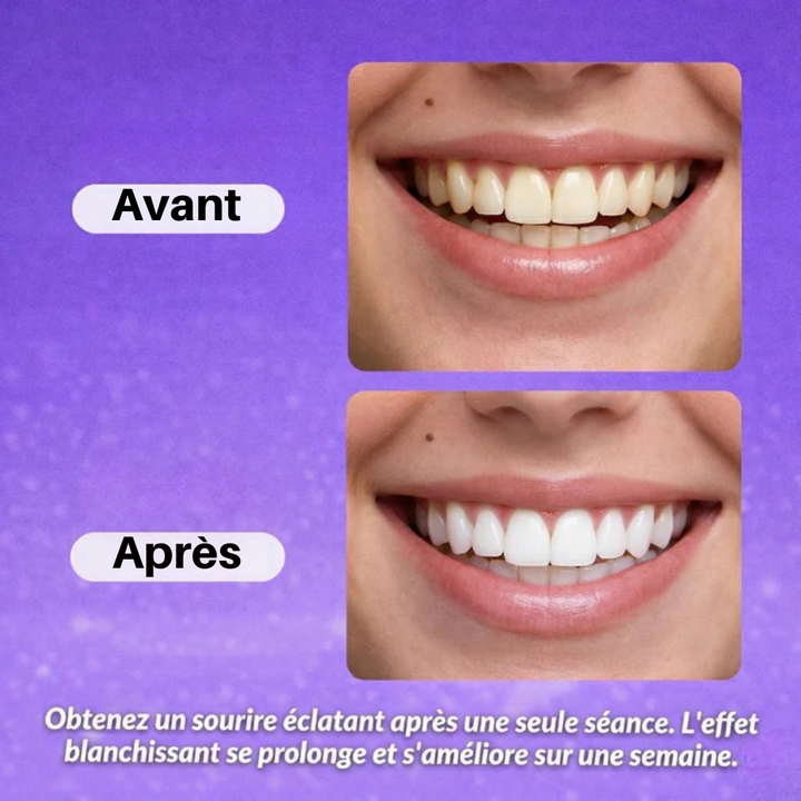 Teeth Whitening Strips | Gel Technology for Even Coverage | 30-Minute Results, Removes Stains, Gentle Formula, Easy Application